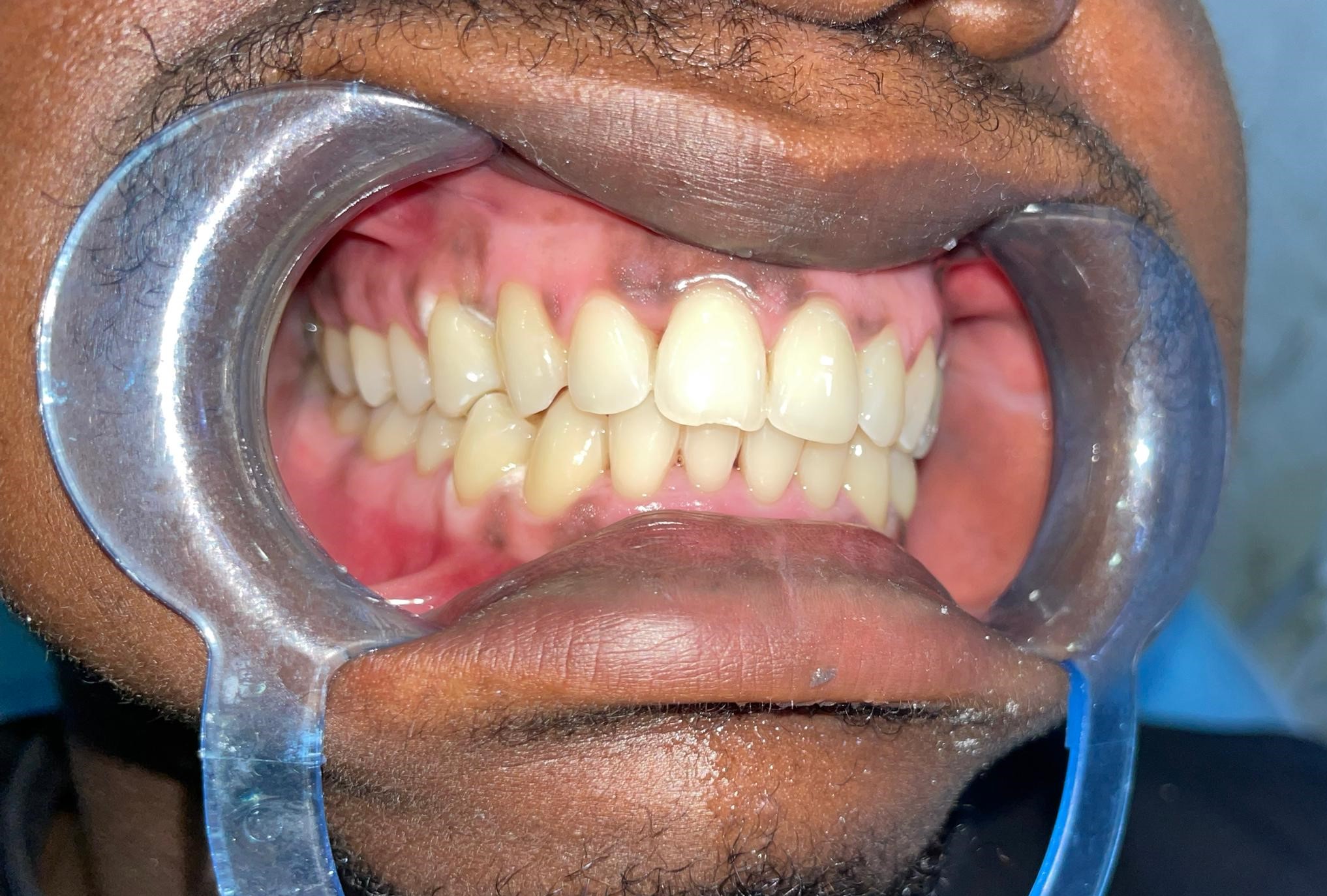 Après blanchiment dentaire