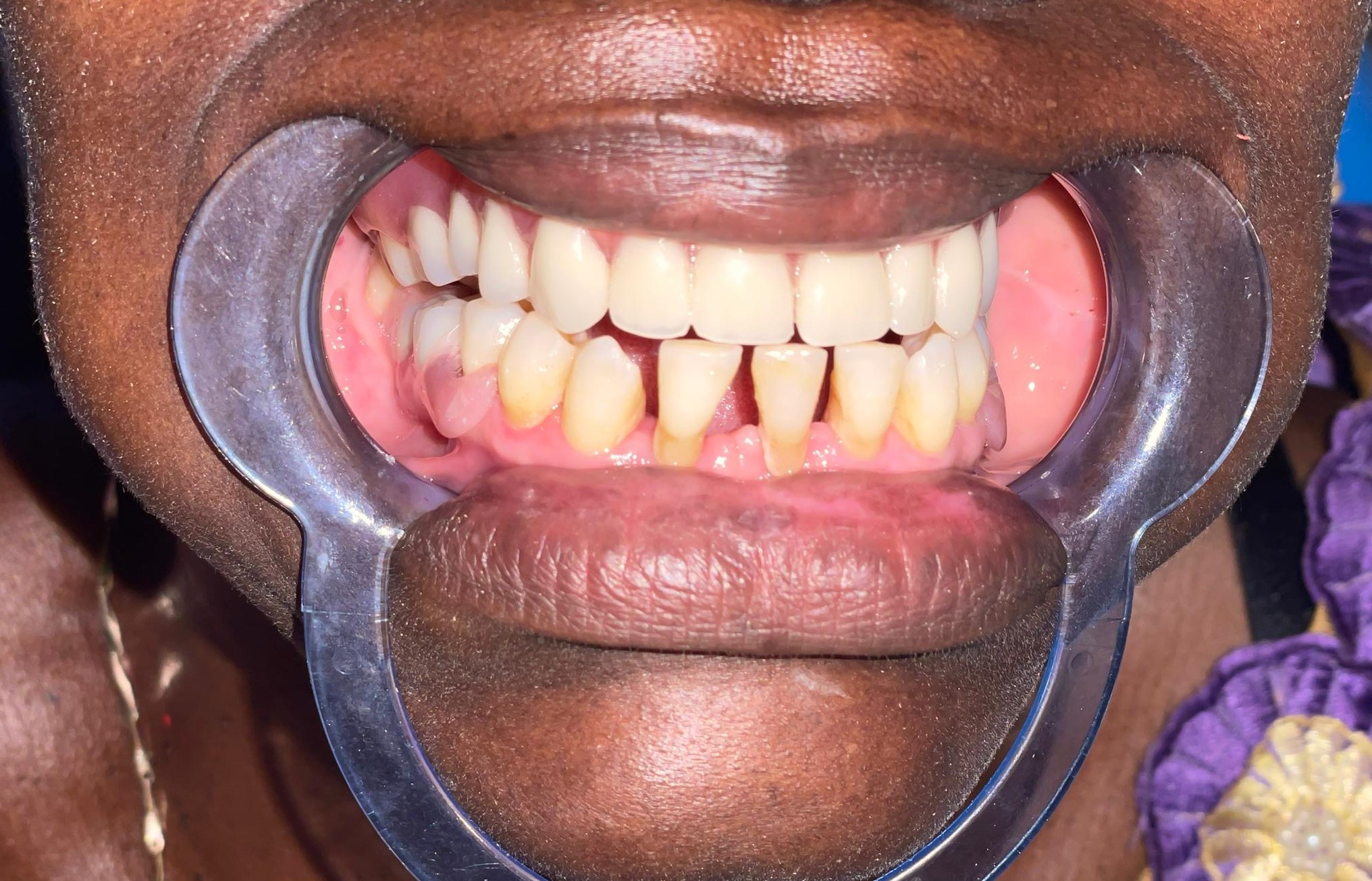 Après prothèse dentaire