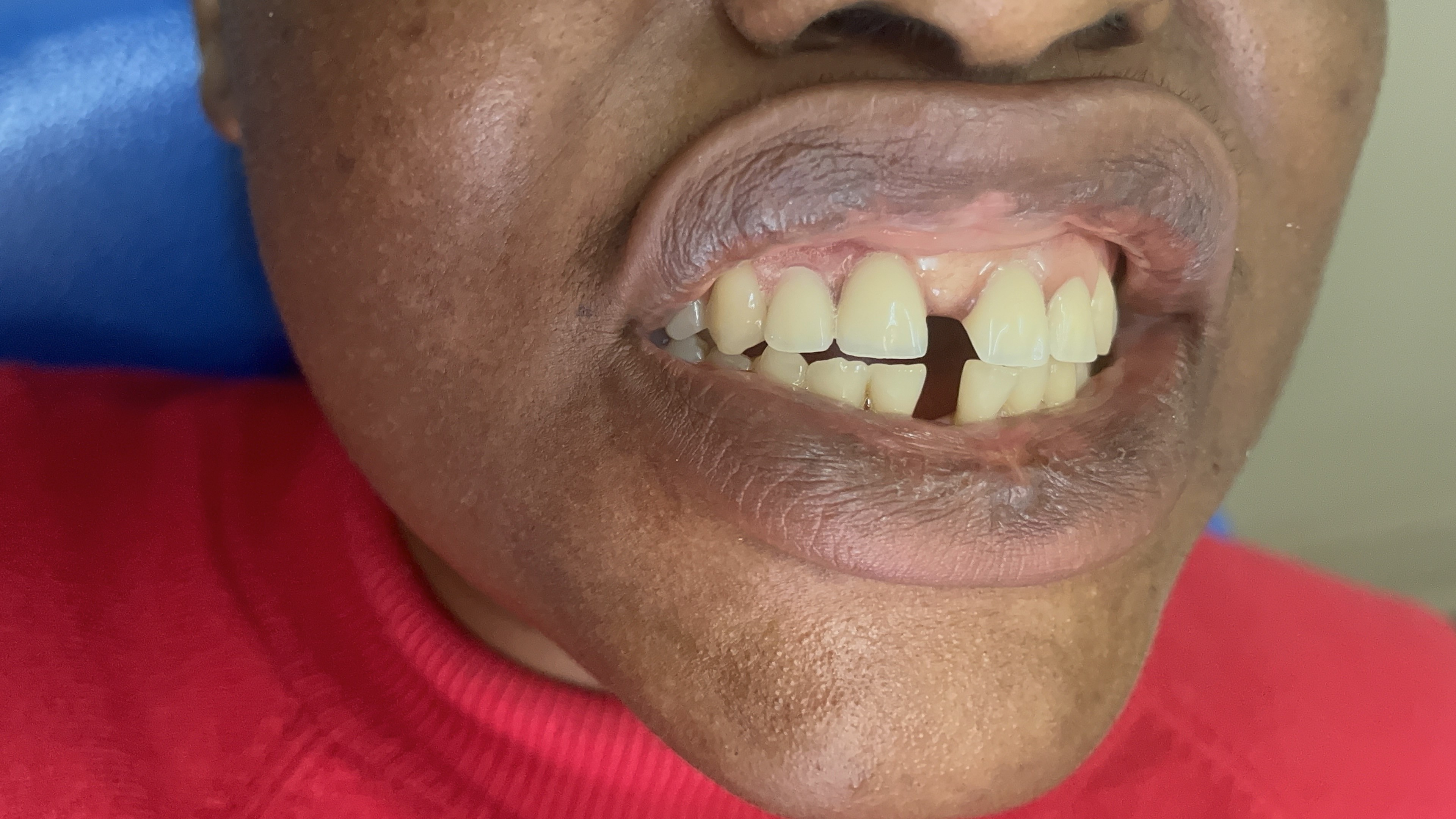 Après prothèse supérieure