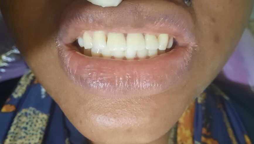 Après prothèse dentaire