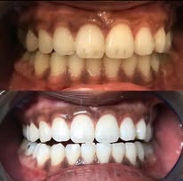 Transformation blanchiment dentaire