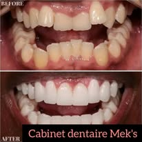 Blanchiment + Orthodontie