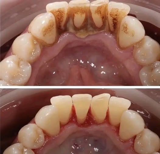 Détartrage dentaire