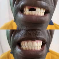 Traitement orthodontique