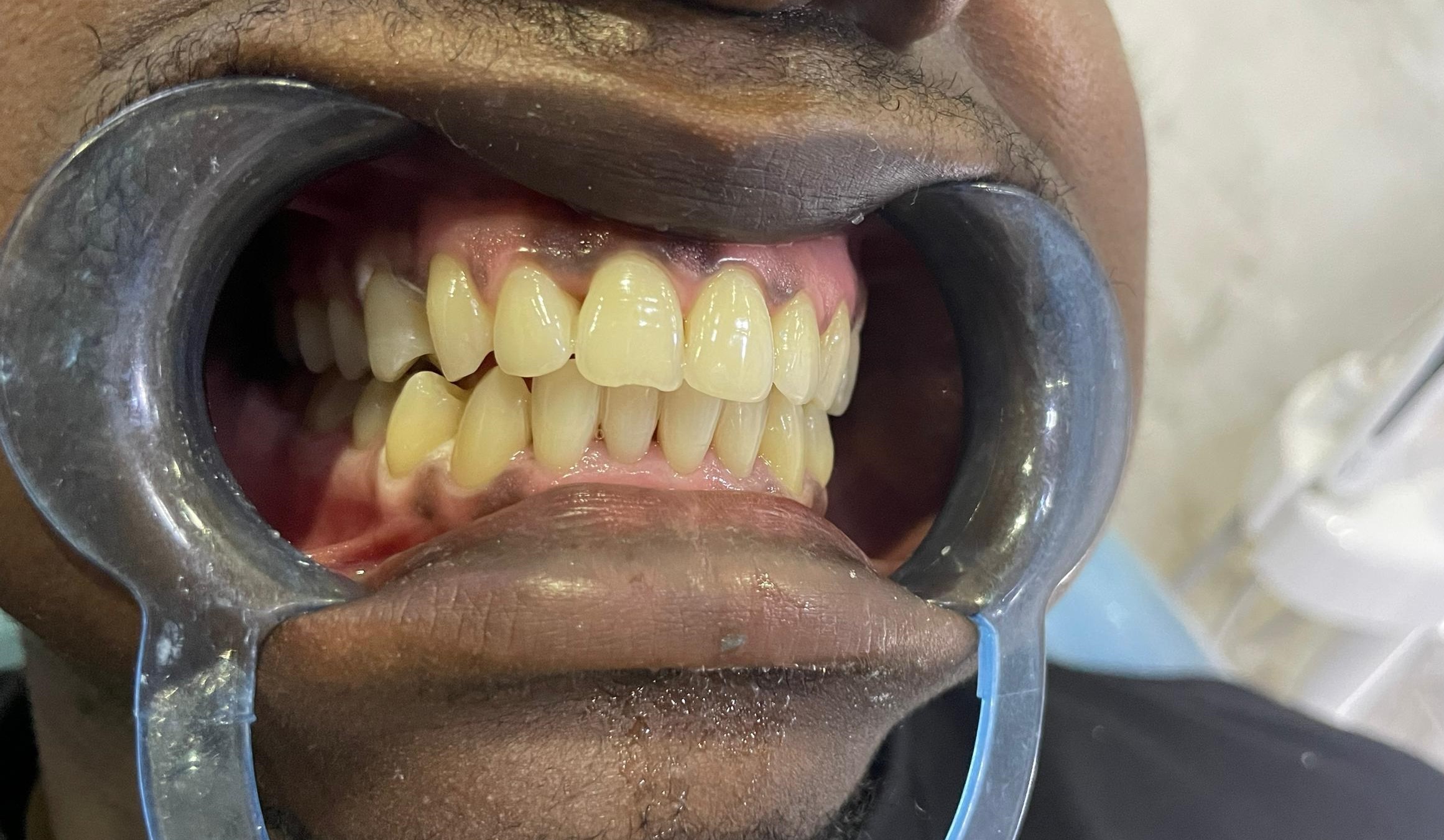 Avant blanchiment dentaire