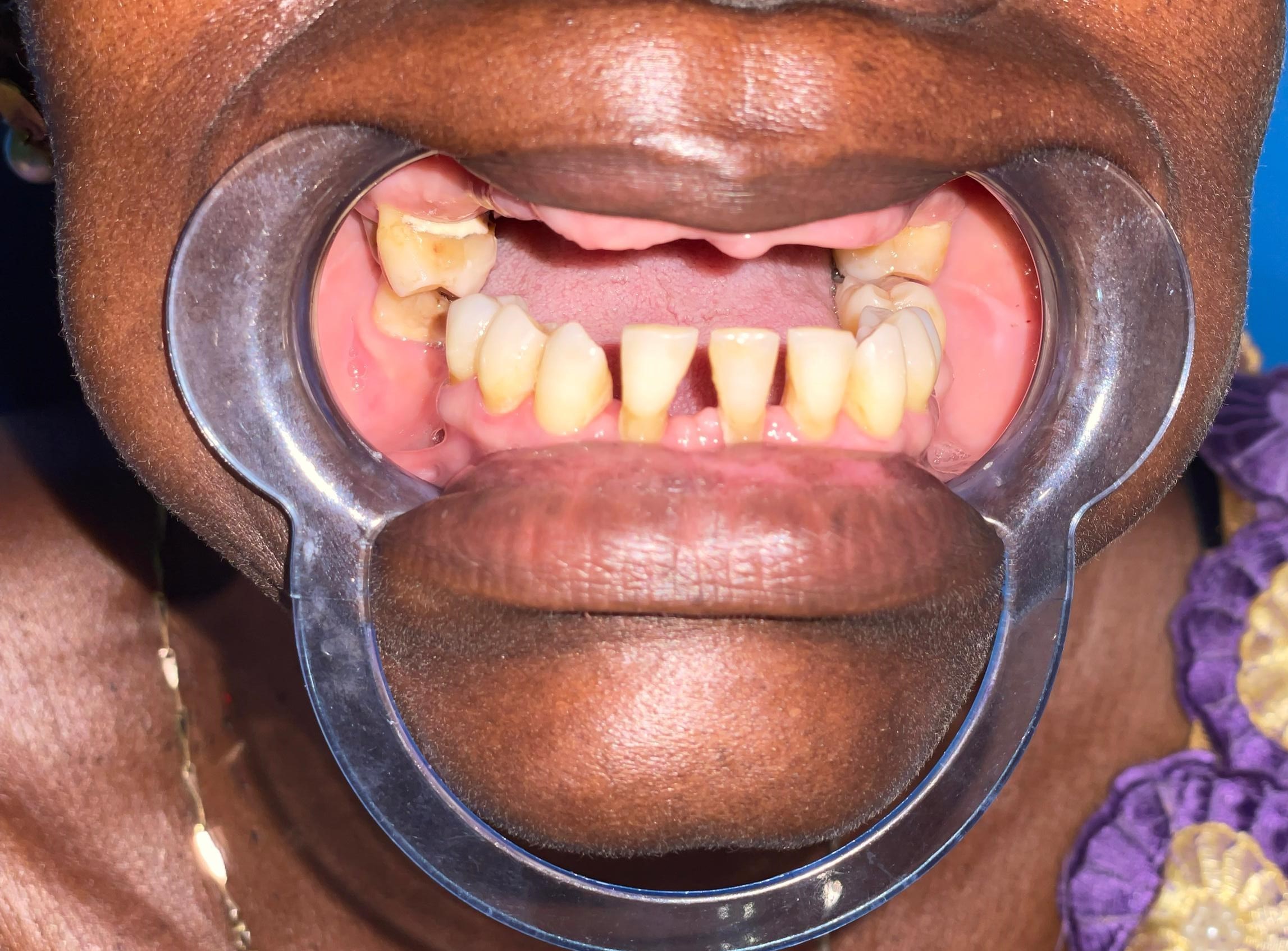 Avant prothèse dentaire