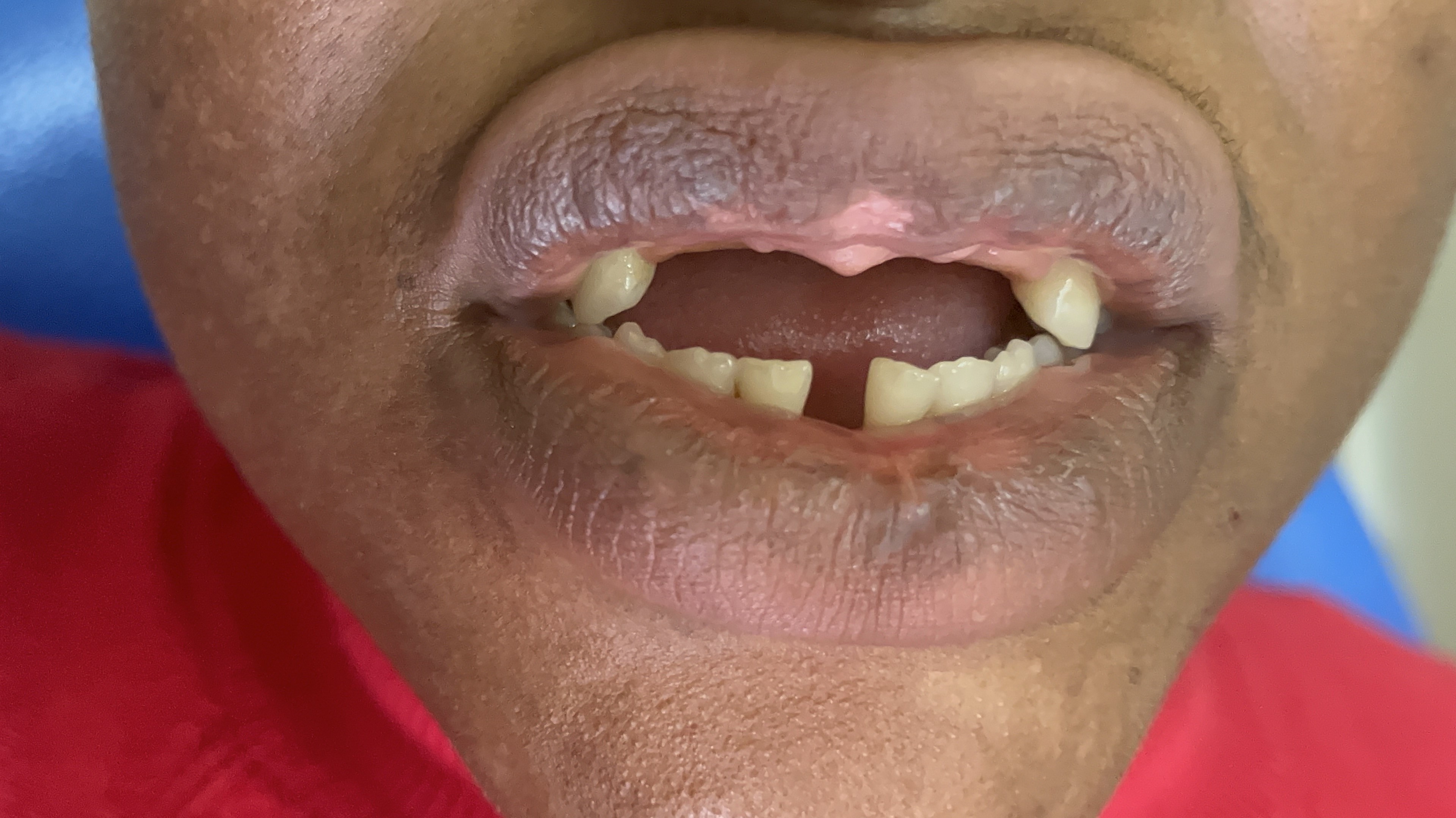 Avant prothèse supérieure