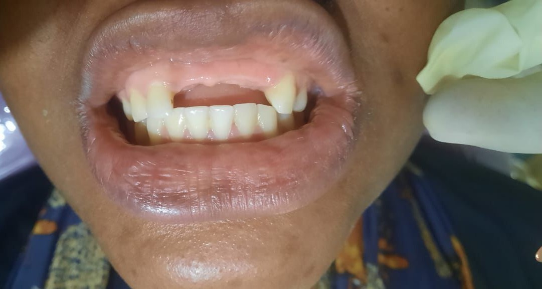 Avant prothèse dentaire